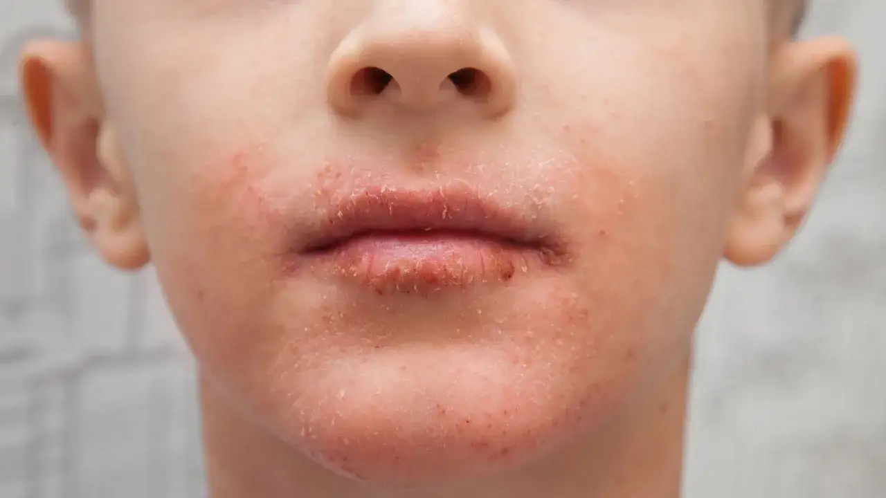 N&auml;rbild p&aring; ett barns mun och haka med rodnad och fj&auml;llande hud, tecken p&aring; perioral dermatit.