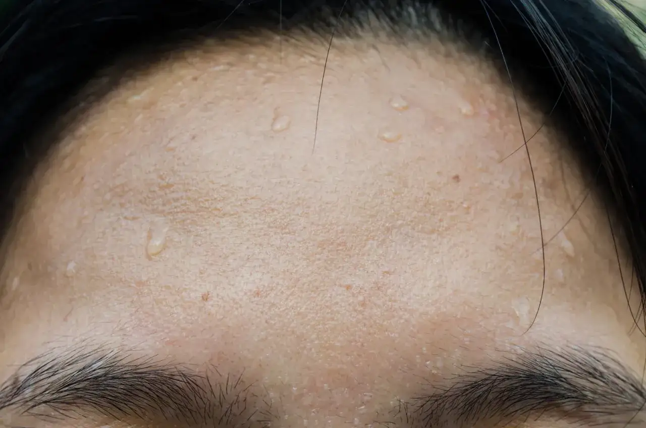 Gouttes de sueur sur le front, signe de transpiration excessive du visage après un effort.