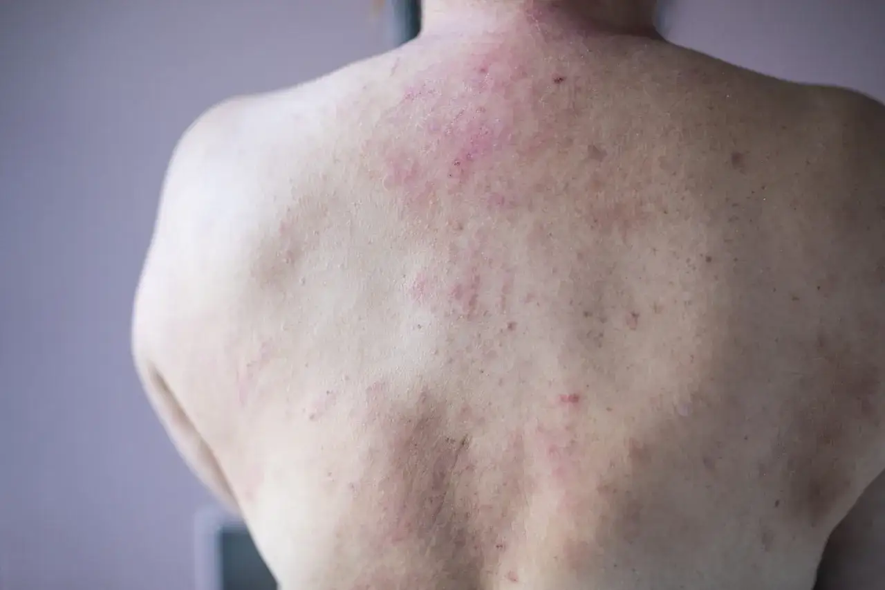 Espalda con erupción de granos por sudor, enrojecimiento e inflamación.
