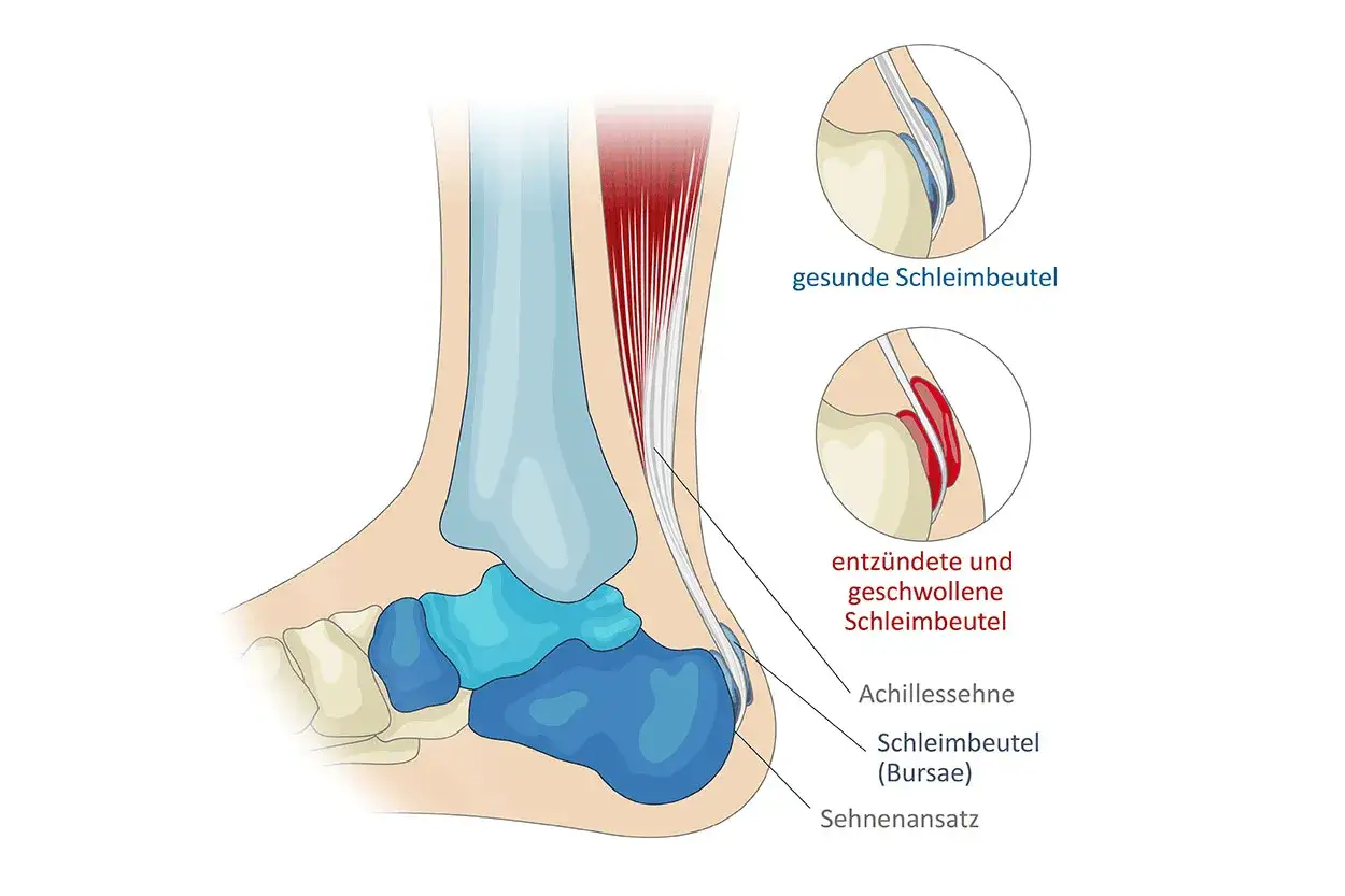 Anatomie des Fußes: Achillessehne, Muskel und Schleimbeutel. Gesunde und entzündete Schleimbeutel werden gezeigt.