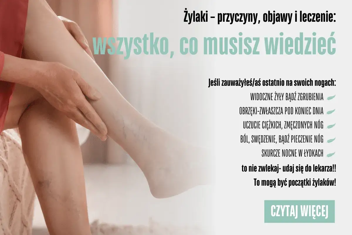 Widoczne żylaki na nogach, obrzęki, ból i uczucie ciężkości mogą świadczyć o początkach żylaków. Nie zwlekaj, udaj się do lekarza!