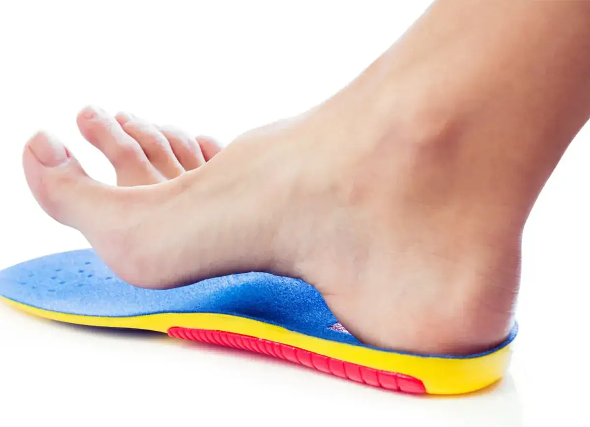 Une semelle orthop&eacute;dique bleue et jaune pour la prise en charge &eacute;pine calcan&eacute;enne, sous un pied humain.