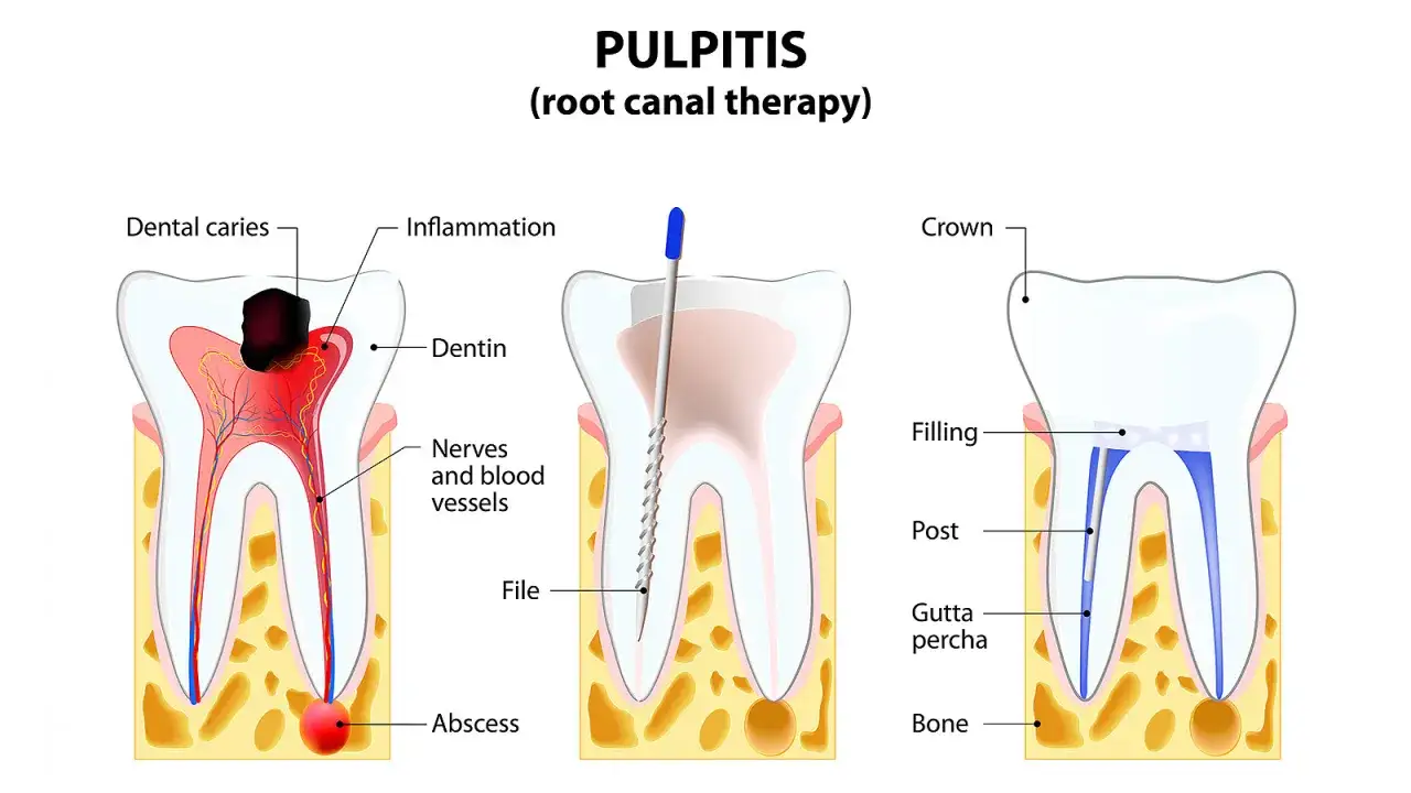Illustrazione di un dente con carie, infiammazione del nervo e rimedi, inclusa la terapia canalare.