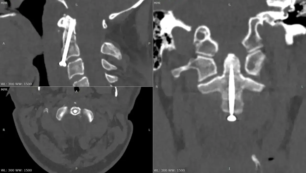 Widok CT kręgosłupa szyjnego po operacji. Widoczny implant stabilizujący, w tym śruba przechodząca przez ząb obrotnika.