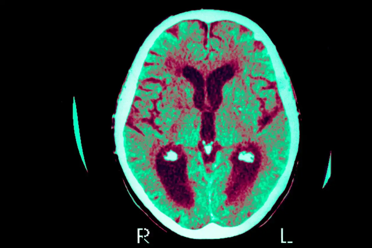 Hirn-CT zeigt Ver&auml;nderungen, die bei der Alzheimer-Behandlung relevant sind. Deutlich erweiterte Ventrikel und Atrophie.