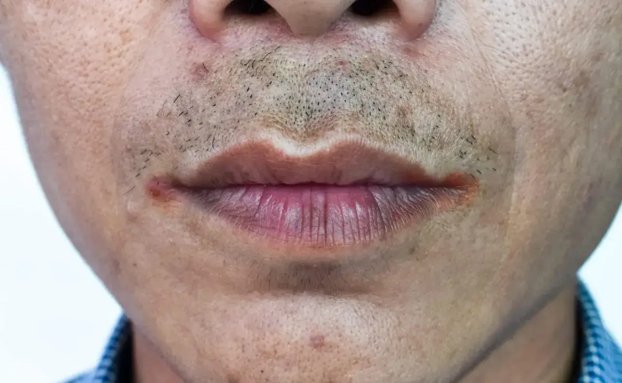 Lèvres gercées et irritées, possiblement dues à une mycose. La peau autour de la bouche présente des rougeurs et des petites lésions.