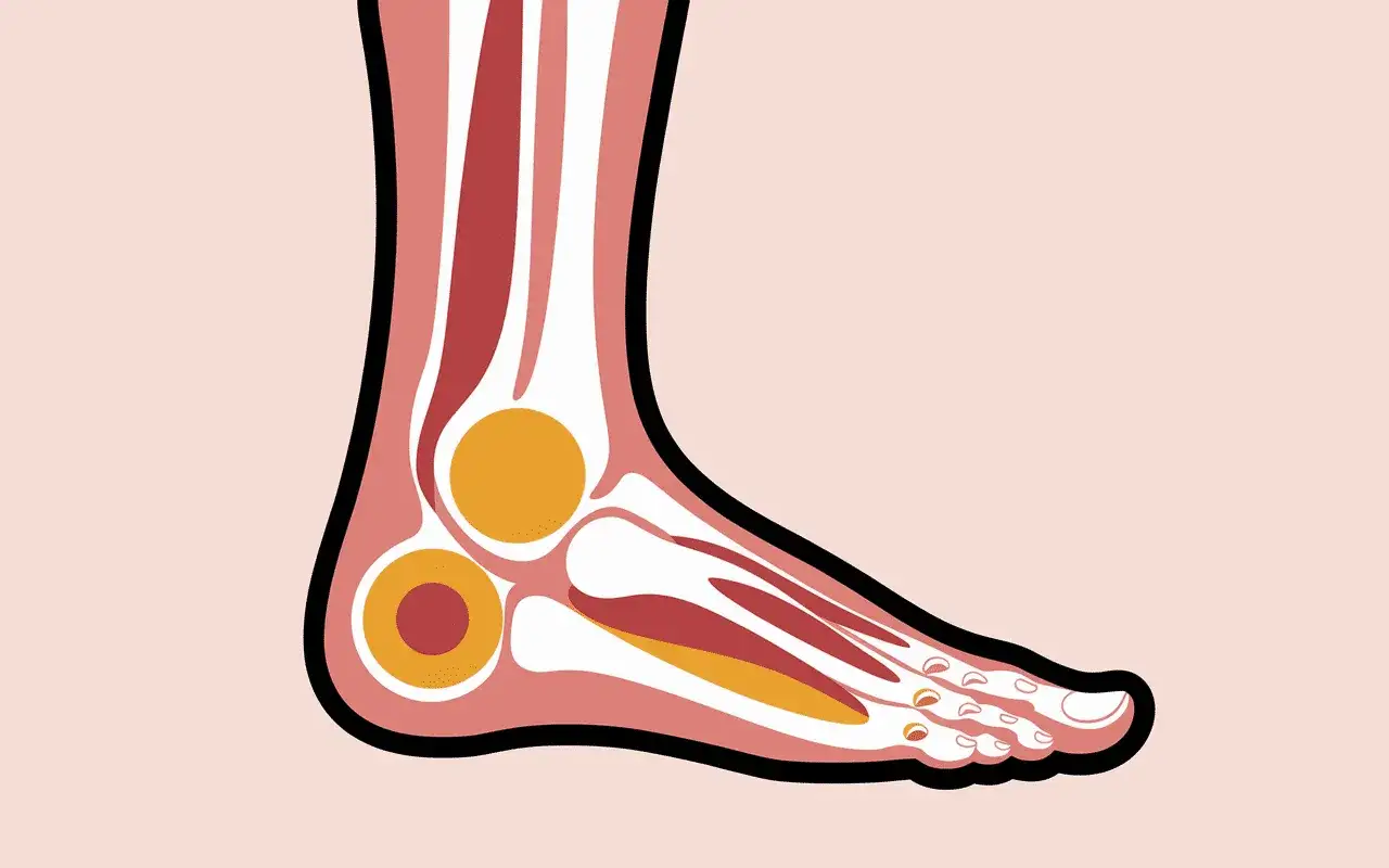 Anatomie du pied montrant les os, les muscles et les tendons. Une zone jaune sugg&egrave;re une possible algodystrophie.