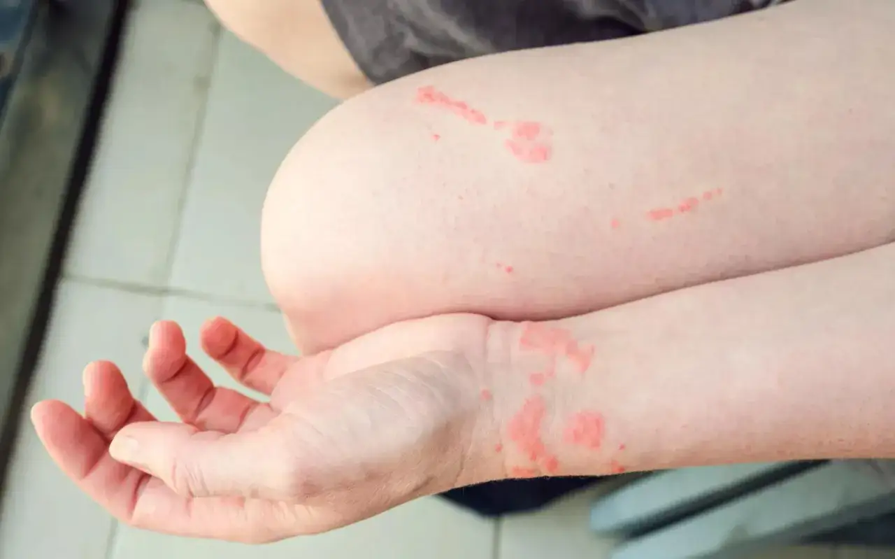 Irritazione cutanea su braccio e polso, con segni rossi che ricordano i tentacoli medusa dopo un incontro inaspettato.