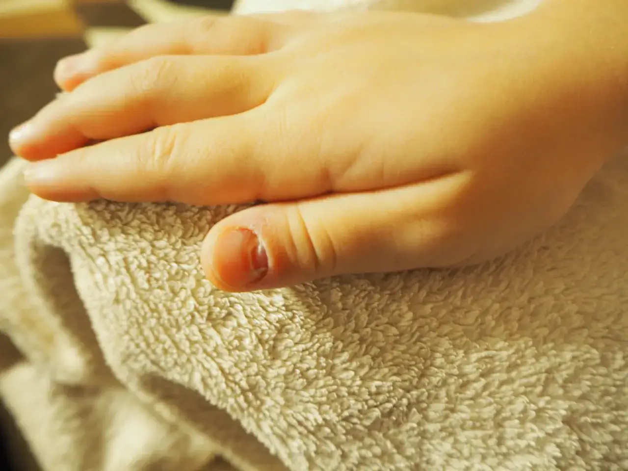 Dziecko ma przytrzaśnięty palec, który jest lekko zaczerwieniony i obolały. Widać zadrapanie pod paznokciem.