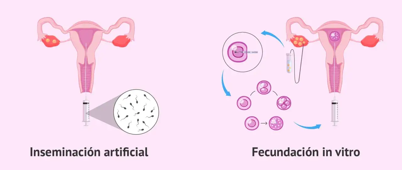 Ilustraci&oacute;n de inseminaci&oacute;n artificial y fecundaci&oacute;n in vitro, dos t&eacute;cnicas de reproducci&oacute;n asistida.