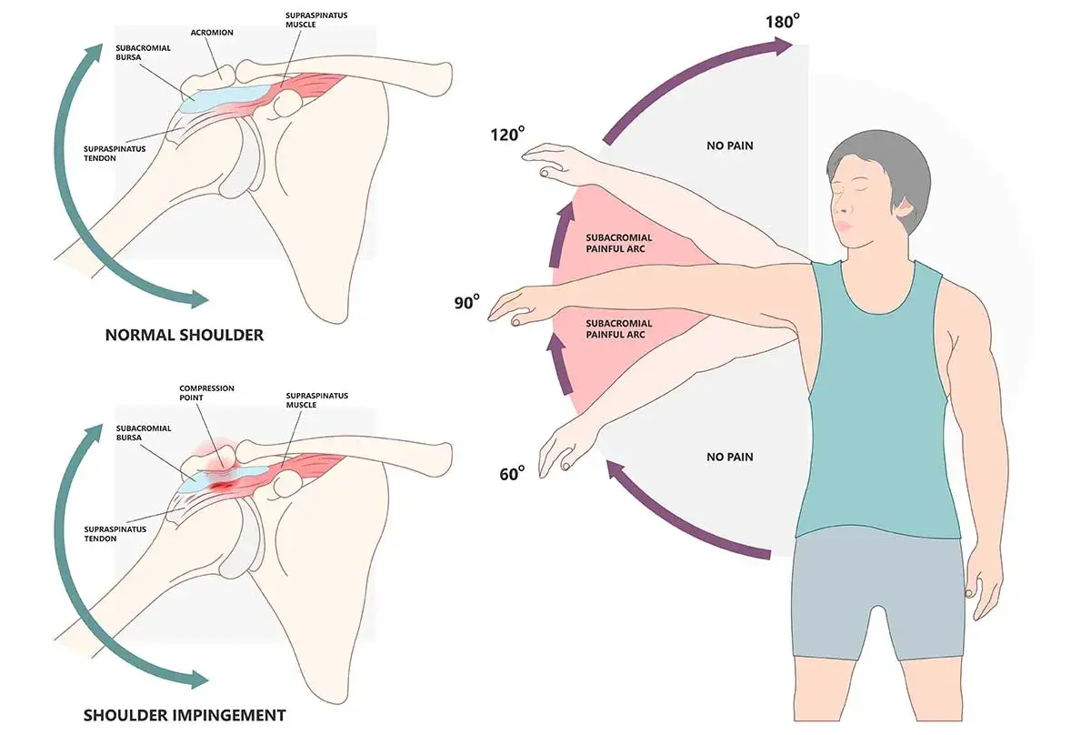 Schulter-Impingement-Syndrom: Schmerzhafter Bogen bei Armhebung zwischen 60° und 120°. Normale Schulter ohne Schmerzen.