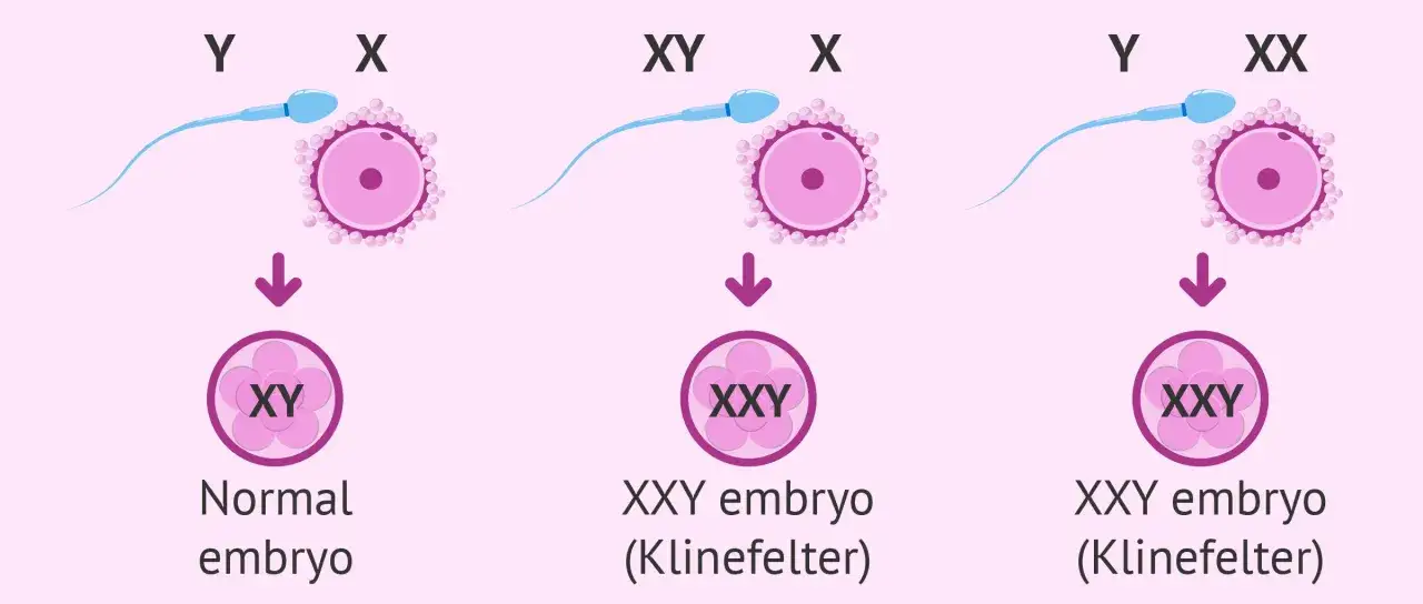 Fecondazione: Y+X=XY (normale), XY+X=XXY (sindrome di Klinefelter), Y+XX=XXY (sindrome di Klinefelter).