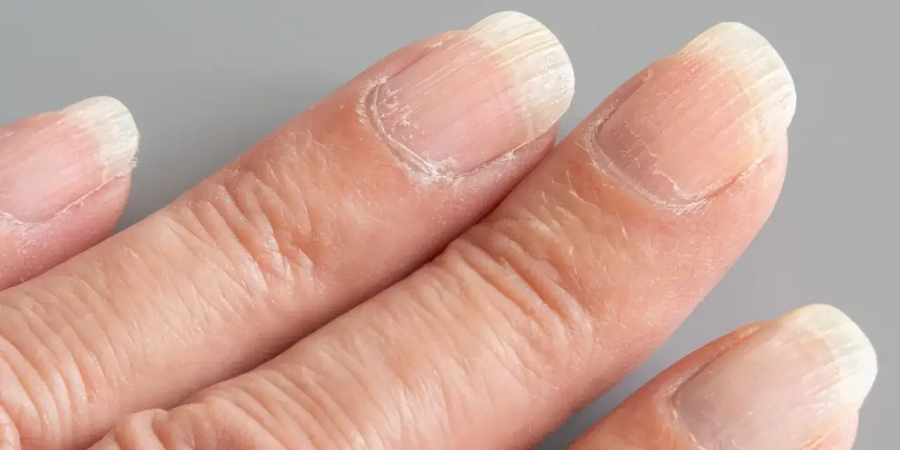 Doigts montrant une peau s&egrave;che et craquel&eacute;e autour d'une plaque de l'ongle ab&icirc;m&eacute;e, avec des stries visibles.