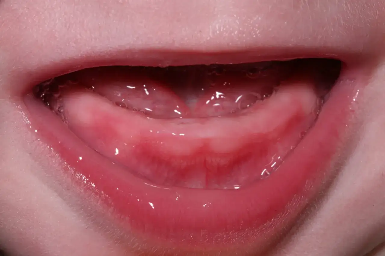 Bocche di neonato con gengive gonfie e arrossate, segno della dentizione. Piccole bollicine di saliva.