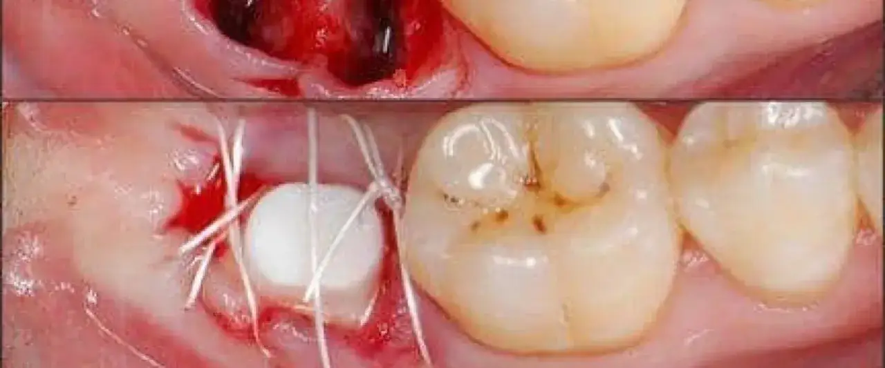 Gojące się dziąsło po wszczepieniu implantu z widocznym materiałem kościotwórczym i szwami.