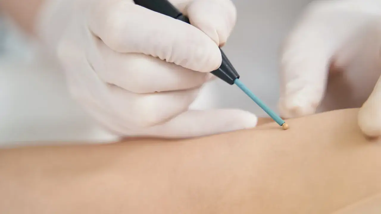 Dermatolog wykonuje elektrokoagulację, usuwając zmianę sk&oacute;rną za pomocą specjalistycznego urządzenia.