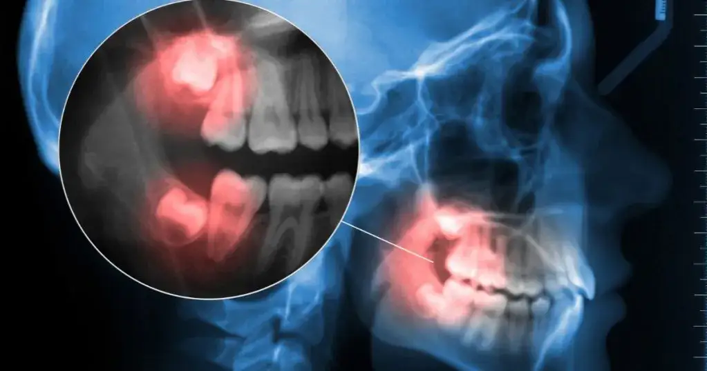 negatywne skutki usunięcia ósemki diastema