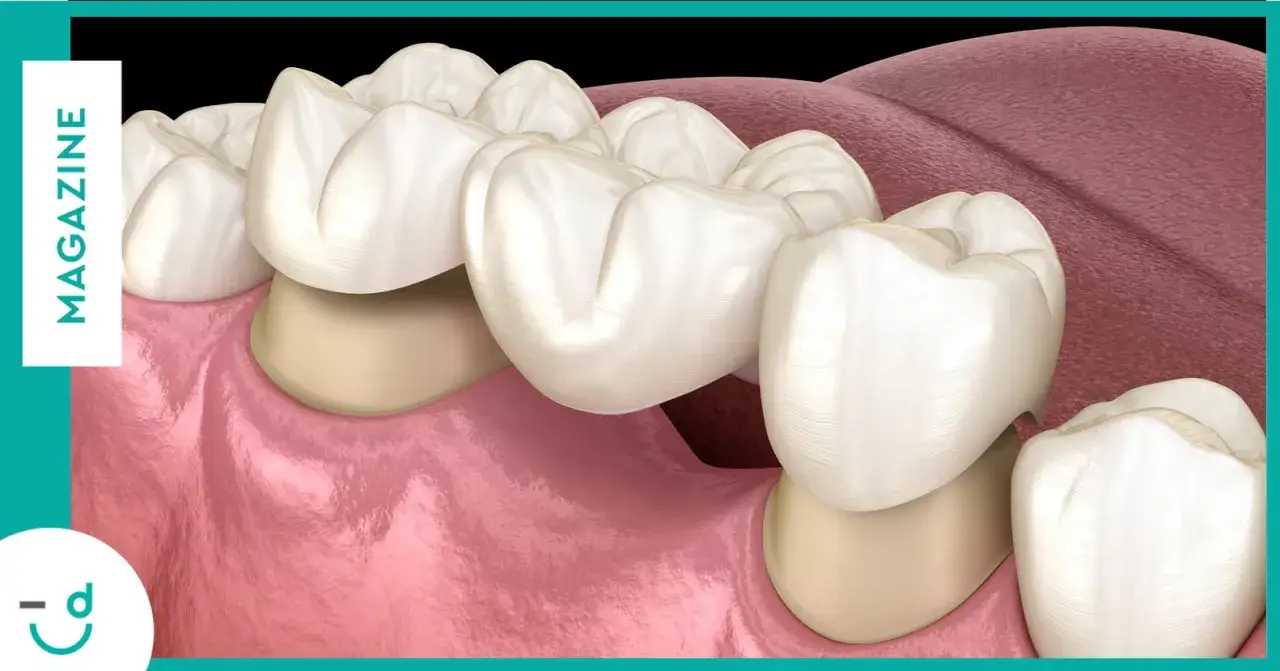 Un ponte dentale, simile a un sorriso sano, ripristina la funzionalit&agrave; e l'estetica dei denti mancanti.
