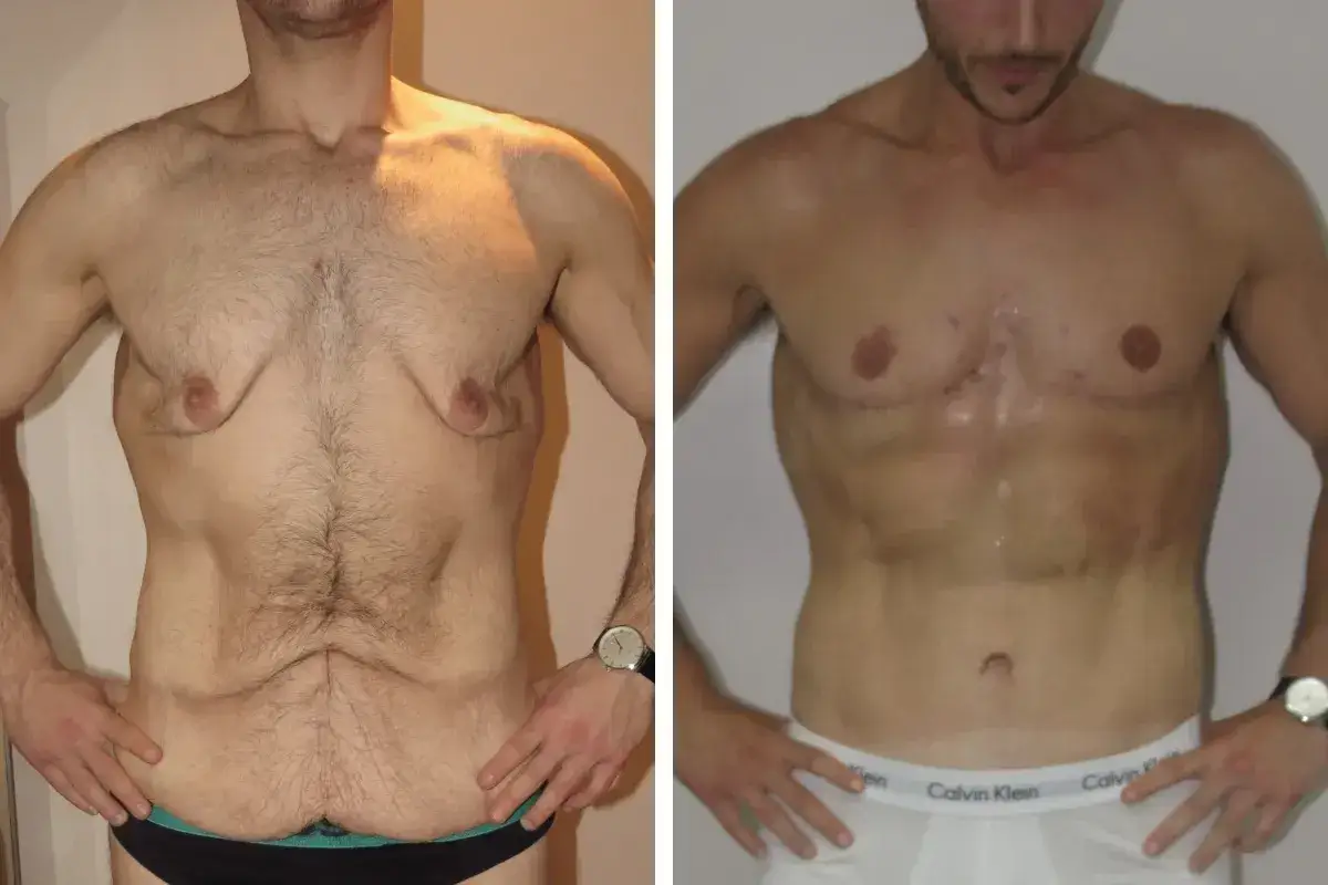 Före- och efterbilder av en mans torso som visar resultat av operation för slapp hud efter viktnedgång.