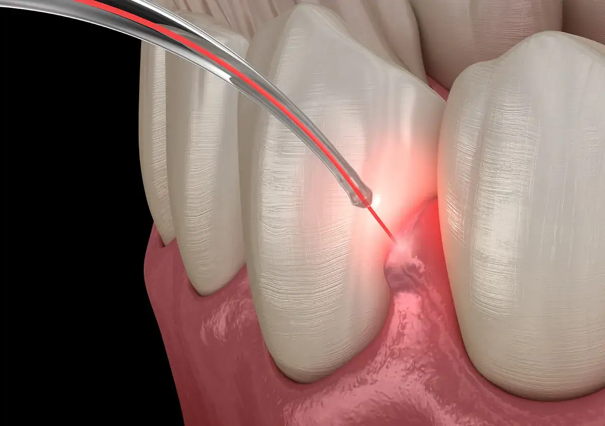Precyzyjne laserowe leczenie paradontozy. Czerwony promień lasera działa na tkankę przyzębia, oferując nowoczesne rozwiązanie.