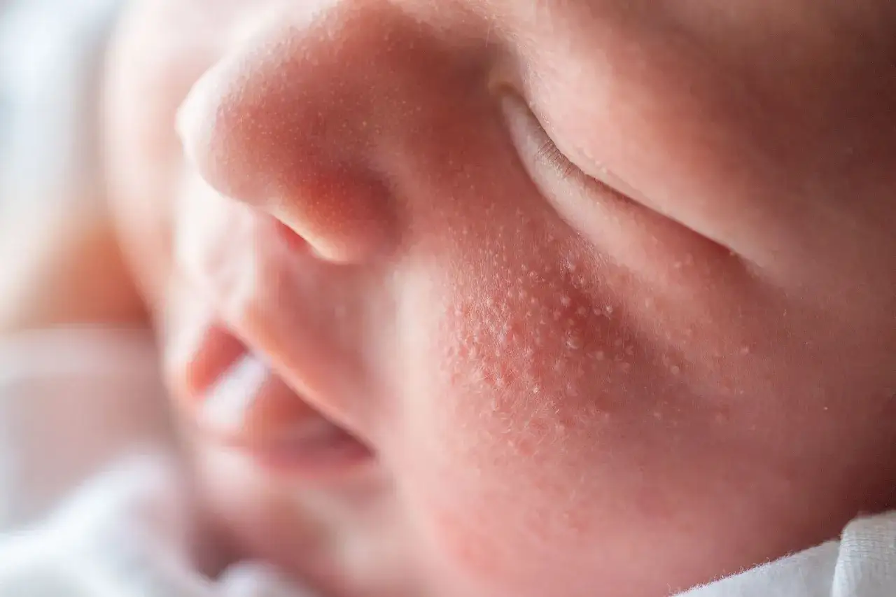 Primer plano de la mejilla de un beb&eacute; con peque&ntilde;os bultos, posible roseola bebe.