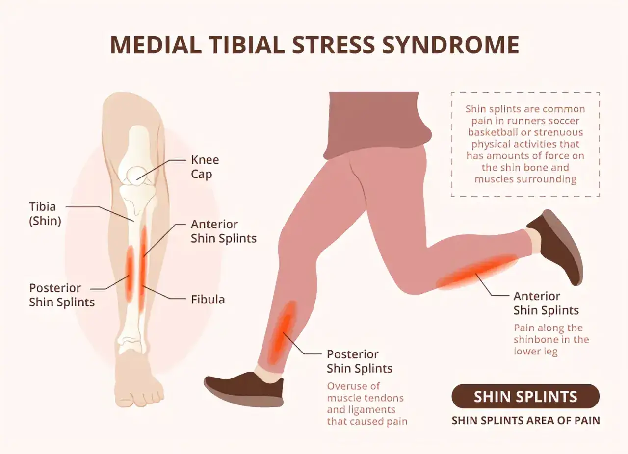 Illustration visar ont i benhinnan (shin splints) på framsidan och baksidan av underbenet, med förklaringar om smärtområden.