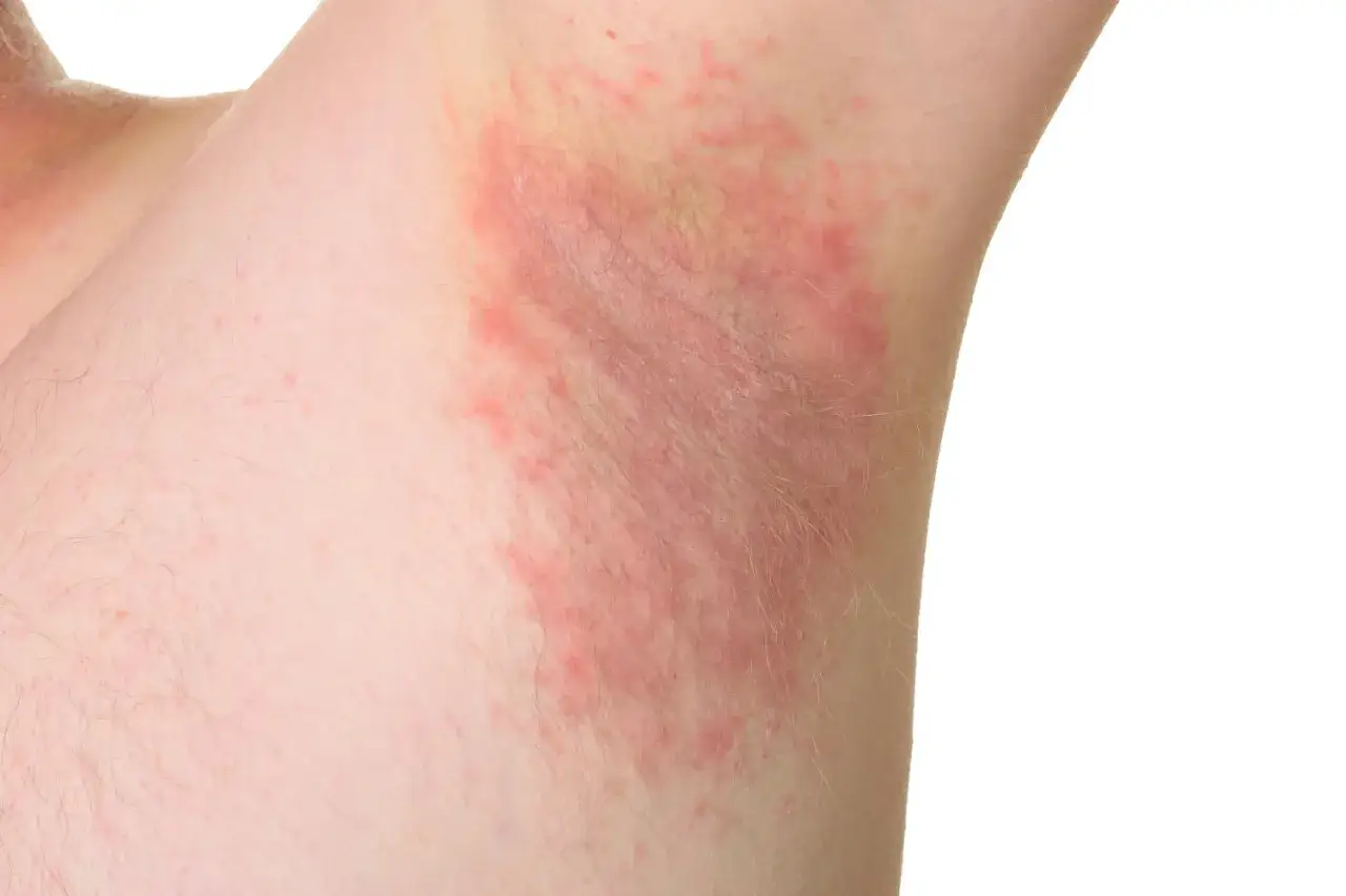 Ascella arrossata e irritata, con segni di dermatite. La cura è fondamentale per alleviare il disagio.