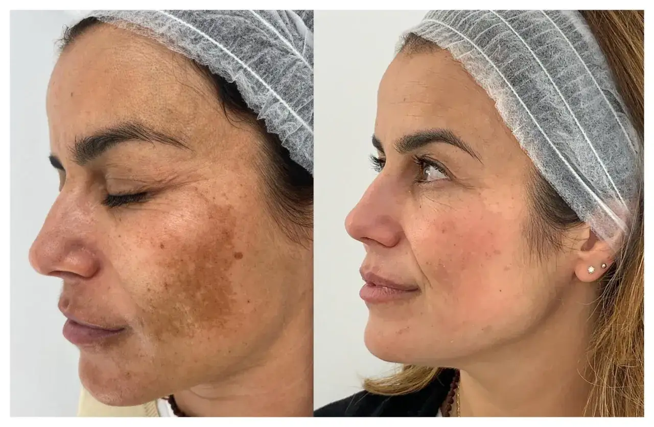 Comparación antes y después de un peeling facial. La piel muestra una reducción notable de manchas y un tono más uniforme.