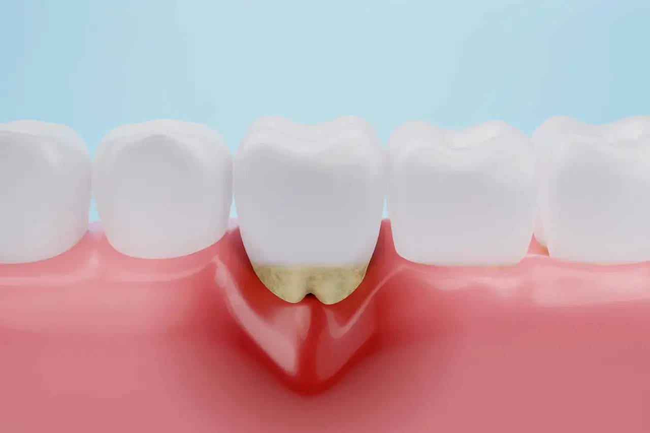 Denti con gengive infiammate e tartaro alla base. La piorrea è curabile con cure dentali adeguate.