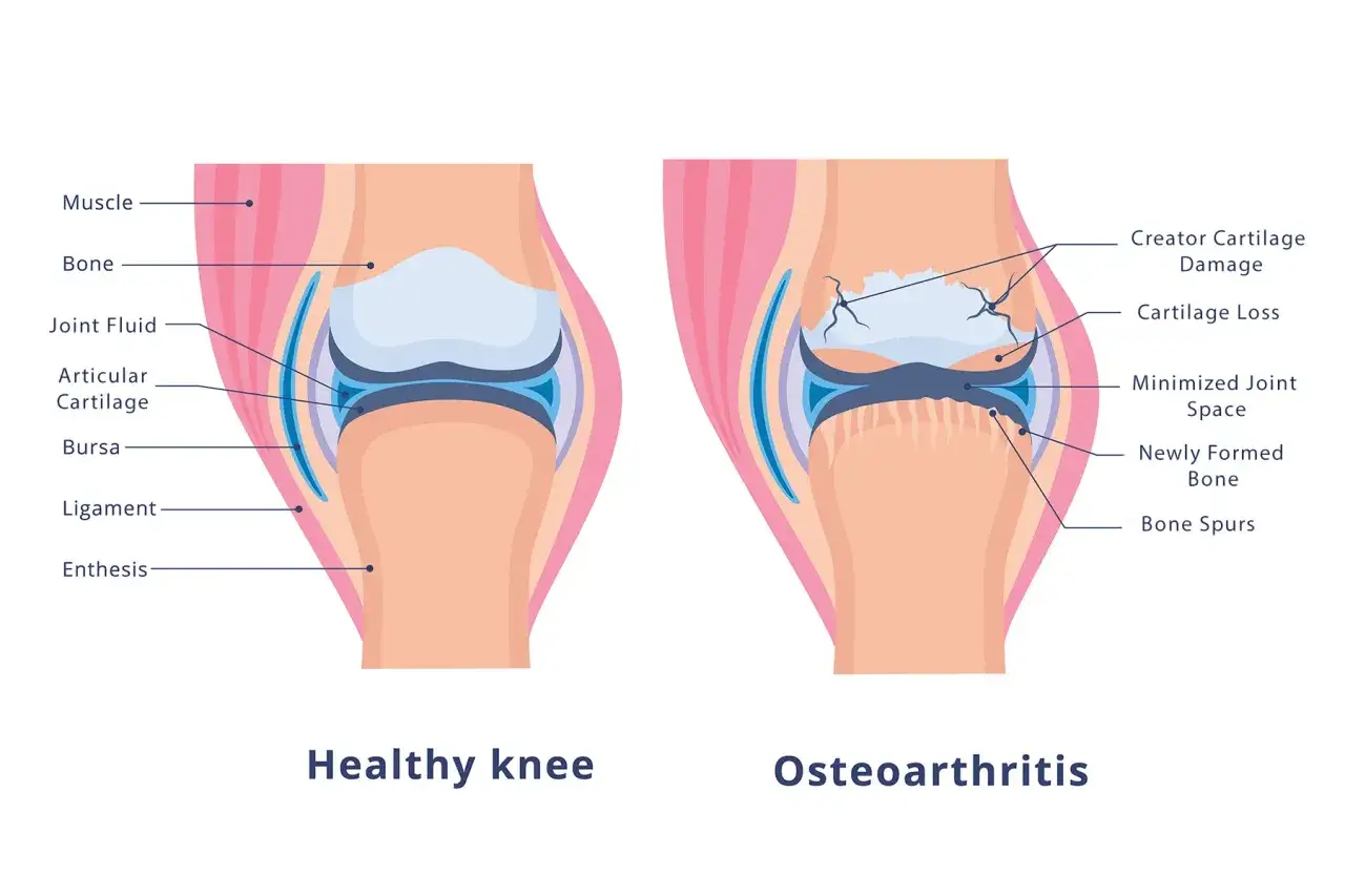 Vergleich gesunder und arthrosegeplagter Knie: Knorpelsch&auml;den, Knochensporne und verengter Gelenkspalt sind typische Ursachen f&uuml;r Arthrose.