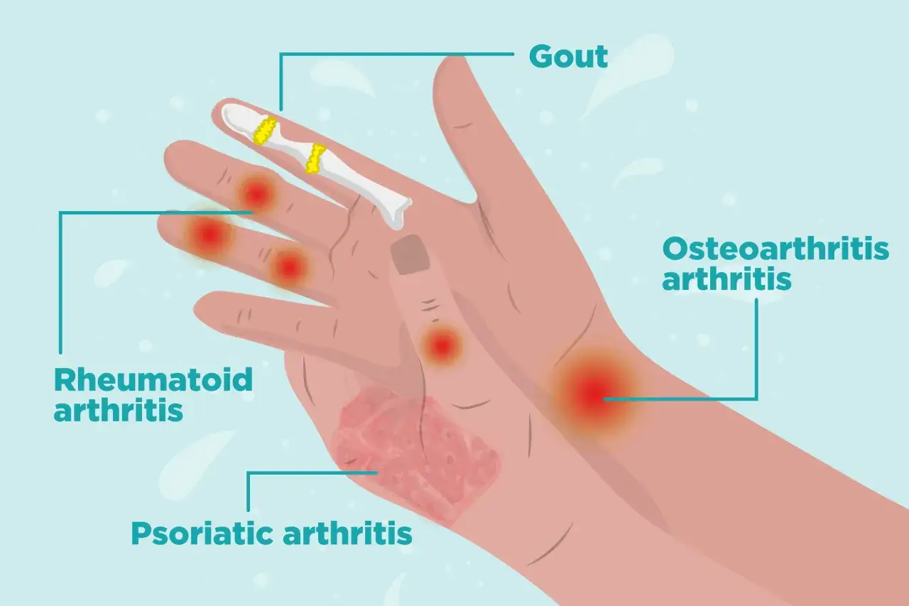 Illustration zeigt verschiedene Arten von Arthritis, wie Gicht, rheumatoide Arthritis, Psoriasis-Arthritis und Osteoarthritis, die sich auf die Gelenke der Hand auswirken.