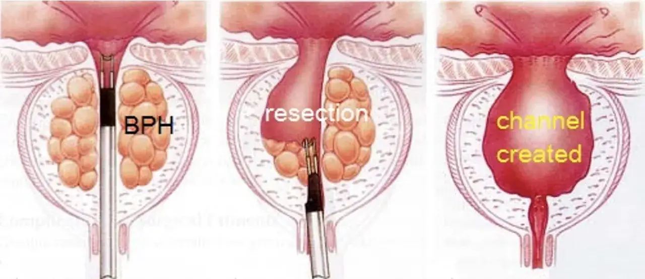 Ilustracja przedstawia zabieg TURP: resekcję przerośniętej prostaty (BPH) i utworzenie kanału.
