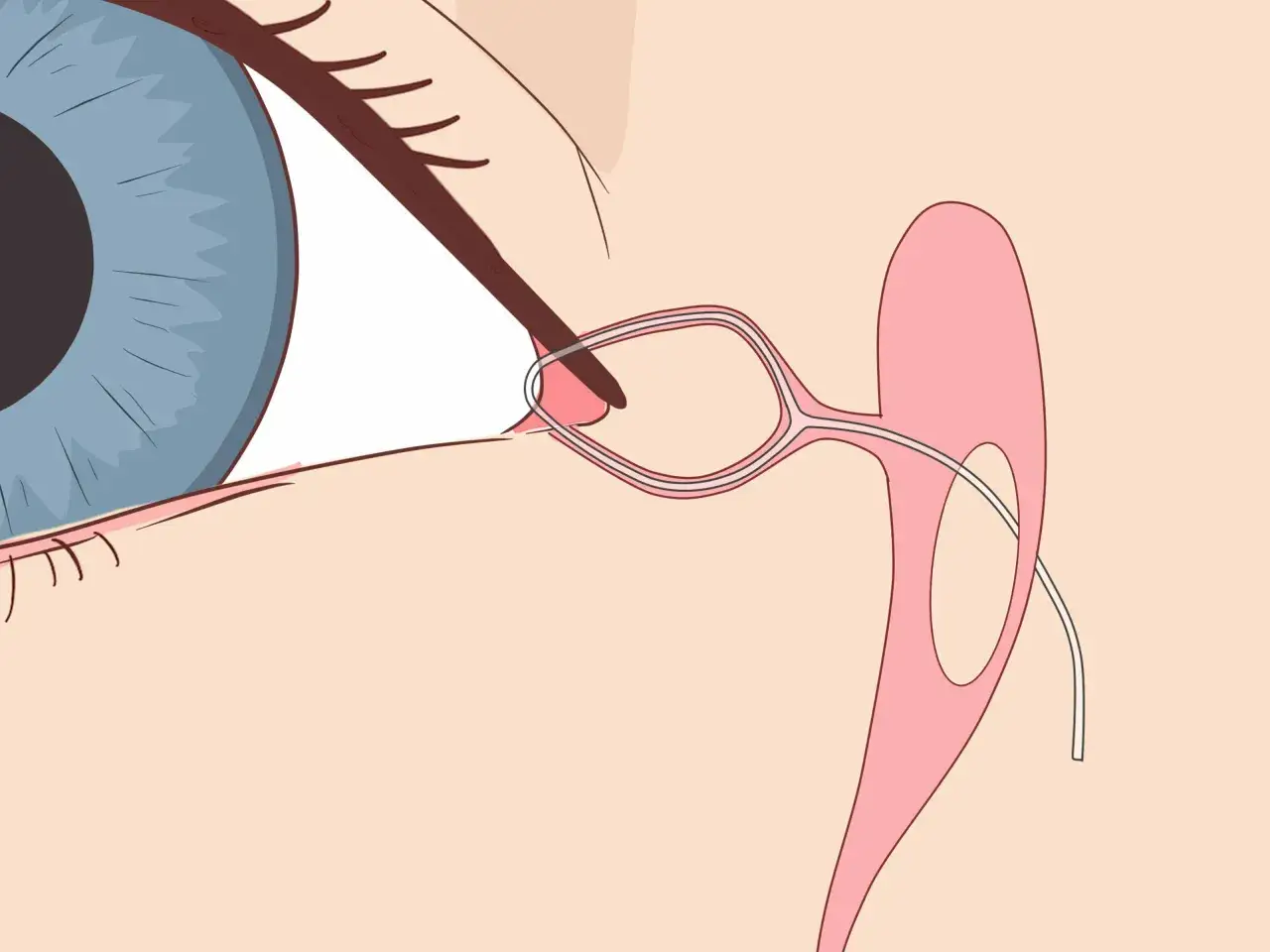 Illustrazione di un occhio con un dispositivo per il massaggio del dotto lacrimale adulto, che mostra il drenaggio delle lacrime.