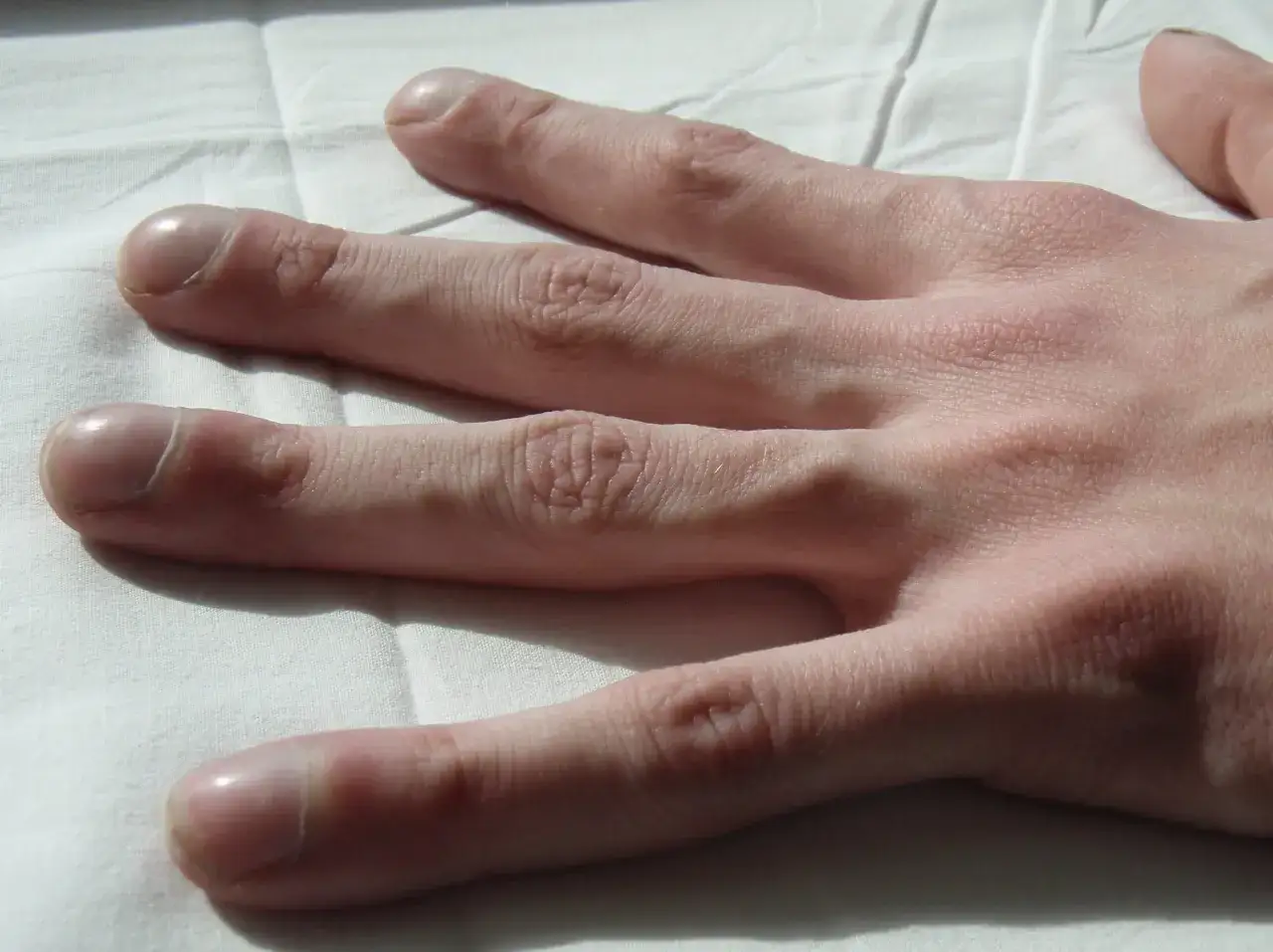 Dita con unghie arrotondate e pelle rugosa, possibili segni di fibrosi cistica alle mani.