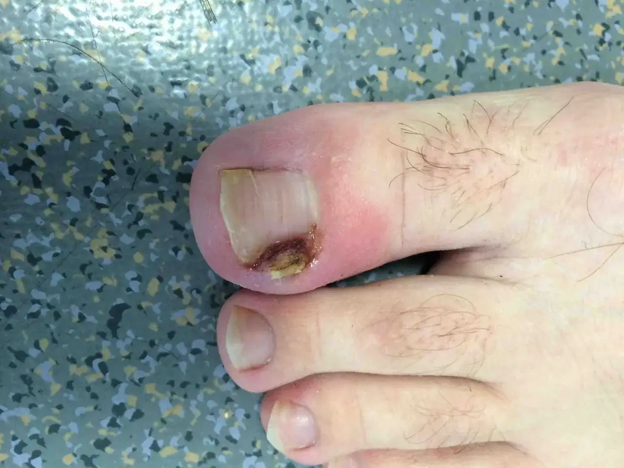 Gros plan sur un ongle de pied présentant un problème : décoloration et aspect abîmé à l'extrémité.