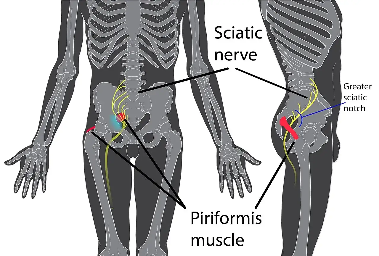 Illustration zeigt den Ischiasnerv, der durch den Piriformis-Muskel verläuft. Ein gereizter Piriformis-Muskel kann das Piriformis-Syndrom verursachen.