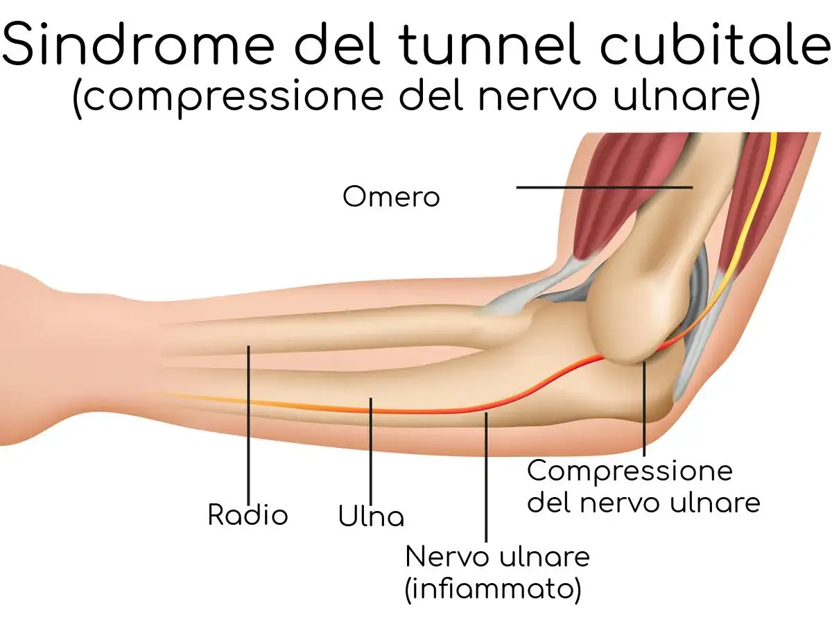 Illustrazione anatomica del gomito che mostra la compressione del nervo ulnare nel tunnel cubitale, con il nervo ulnare infiammato.