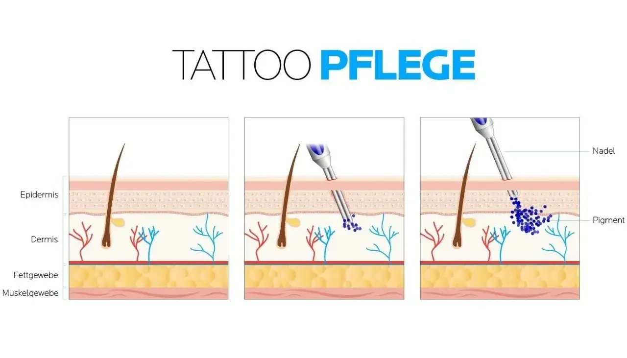 Illustration zeigt die Hautschichten und wie Pigmente durch eine Nadel entfernt werden, was auf eine Tattoo-Entfernung hindeutet.