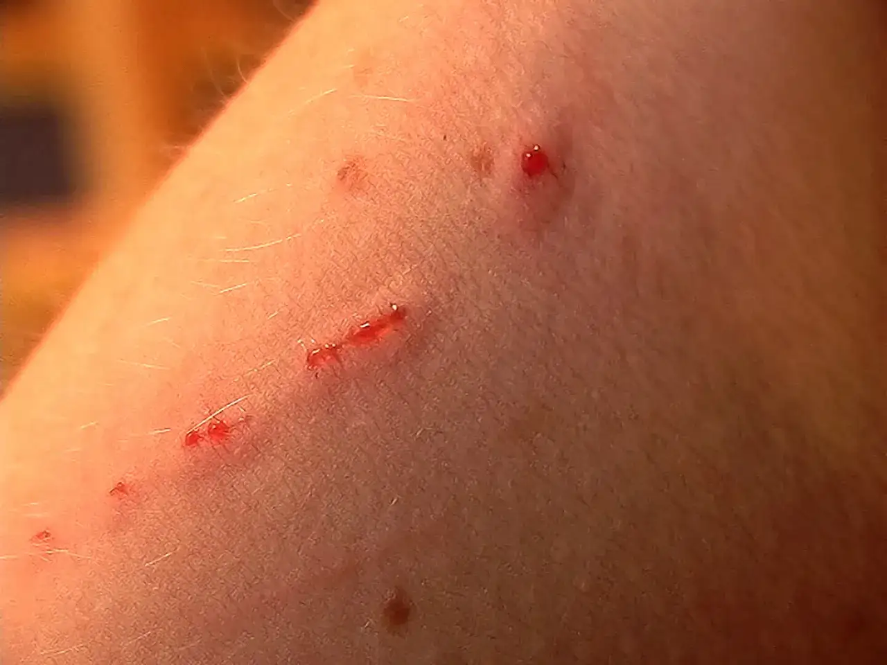 Skóra z kilkoma zaczerwienionymi, krwawiącymi zadrapaniami, przypominającymi objawy choroby kociego pazura.