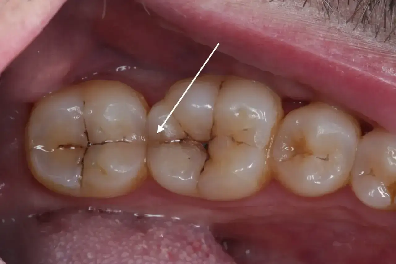Denti con otturazioni visibili e sottili crepe nello smalto. Una freccia bianca indica una crepa.