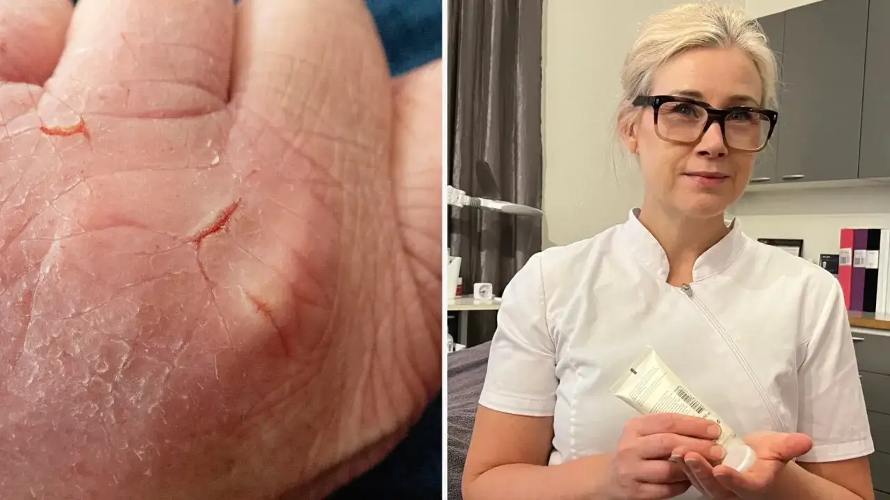 Nära bild på spruckna fingertoppar med blod. Till höger en kvinna i vit rock som håller en tub kräm.