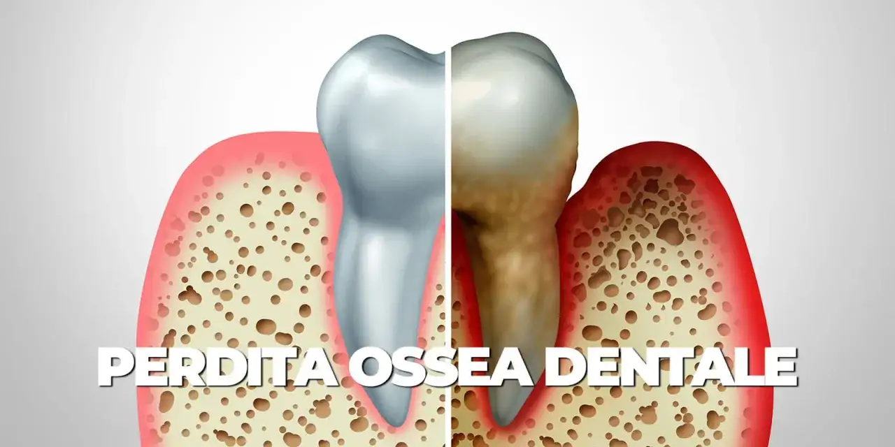 Illustrazione di un dente sano e uno malato, con evidenza del riassorbimento osseo alveolare diffuso di tipo orizzontale e verticale.