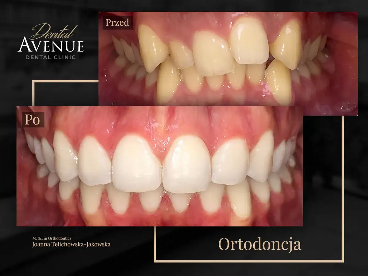Aparat estetyczny przed i po: krzywe zęby wyprostowane dzięki ortodoncji. Piękny uśmiech w Dental Avenue.