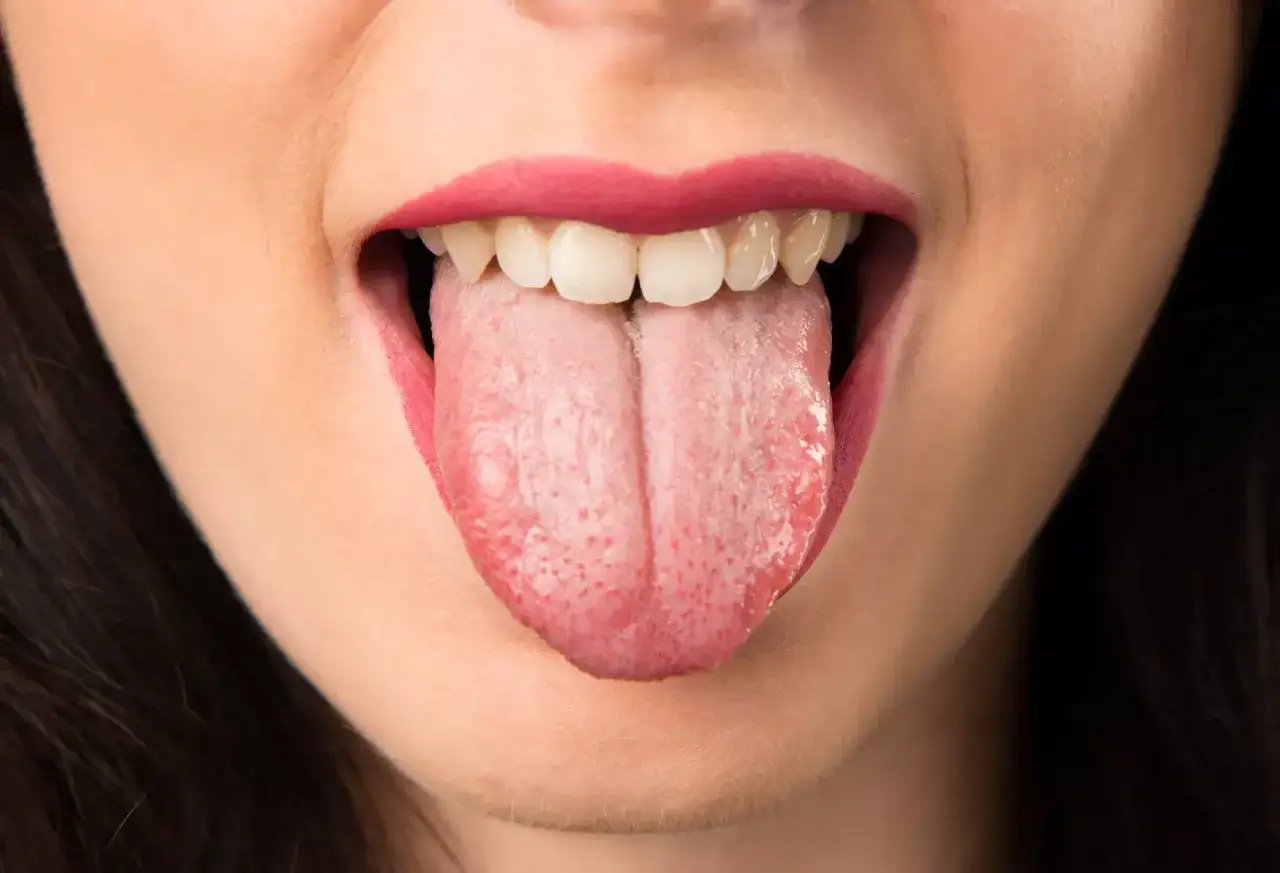 Boca abierta mostrando lengua rosada con peque&ntilde;as manchas rojas, reflejo de la ansiedad en la boca. Labios pintados de rosa.