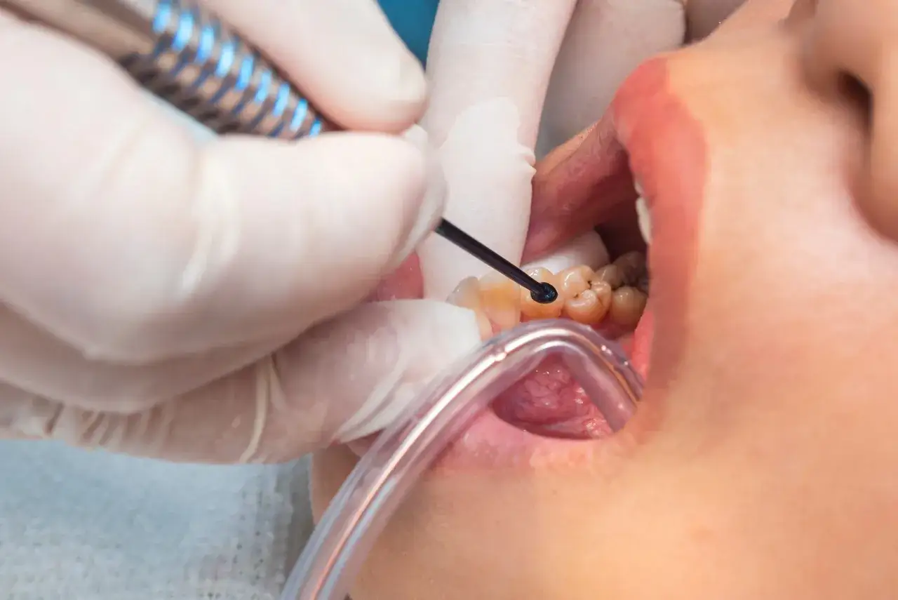 Dentysta wykonuje leczenie zachowawcze zęba, używając wiertła i aspiratora.