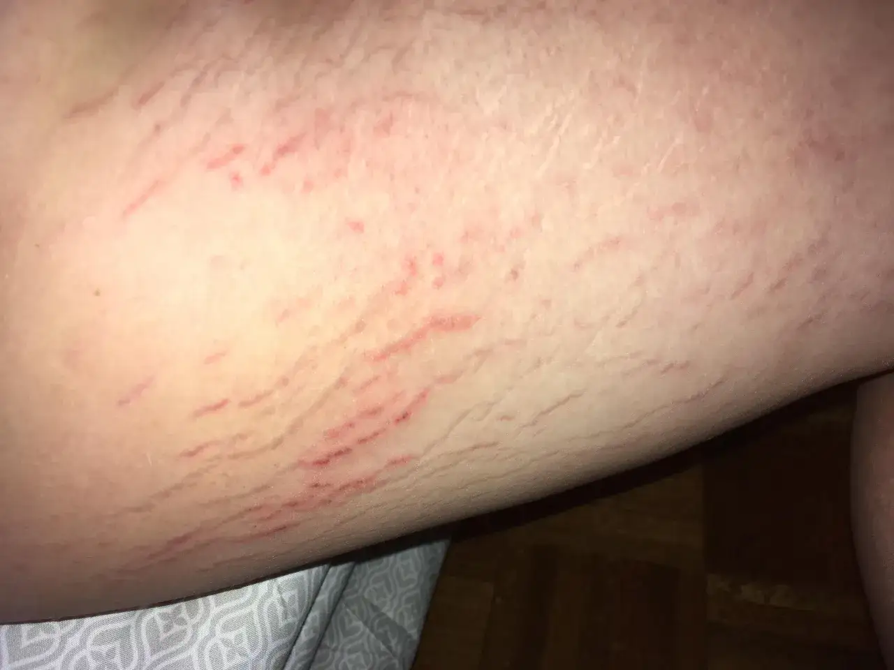 Pelle chiara con evidenti smagliature sull'interno coscia, alcune rosse e altre più chiare, che disegnano linee ondulate sulla superficie cutanea.