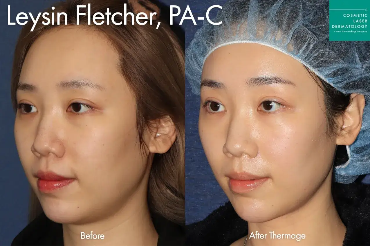 Comparación antes y después de un tratamiento facial con Thermage FLX, mostrando una piel más firme y rejuvenecida.