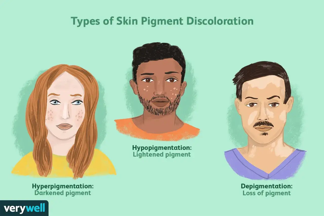 Drei Gesichter zeigen verschiedene Arten von Hautpigmentver&auml;nderungen: Hyperpigmentierung (dunkler pigment), Hypopigmentierung (hellerer pigment) und Depigmentierung (pigmentverlust).