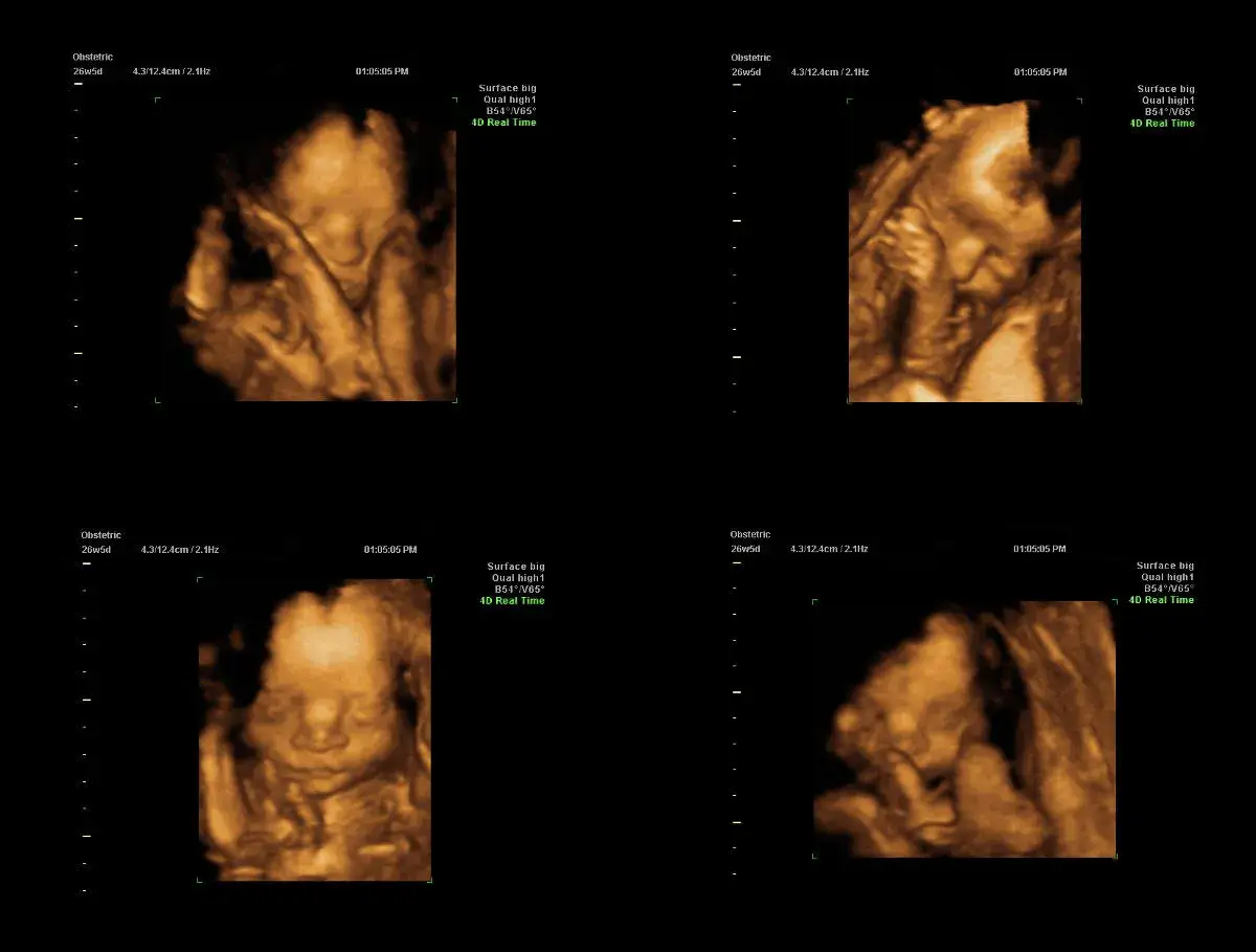 Ecografie 4D di un feto a 26 settimane. Queste immagini mostrano il viso e il corpo del bambino, utili per valutare la crescita e lo sviluppo, e per capire quando si fa la villocentesi.
