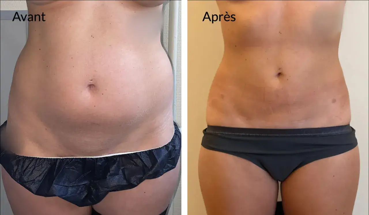 Avant/Après : une transformation visible du ventre après liposuccion. La silhouette est affinée, les courbes redessinées.
